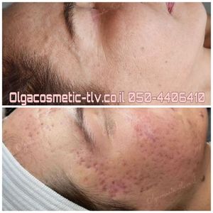 Косметологи | Ольга Шимон косметолог пара-медицинский