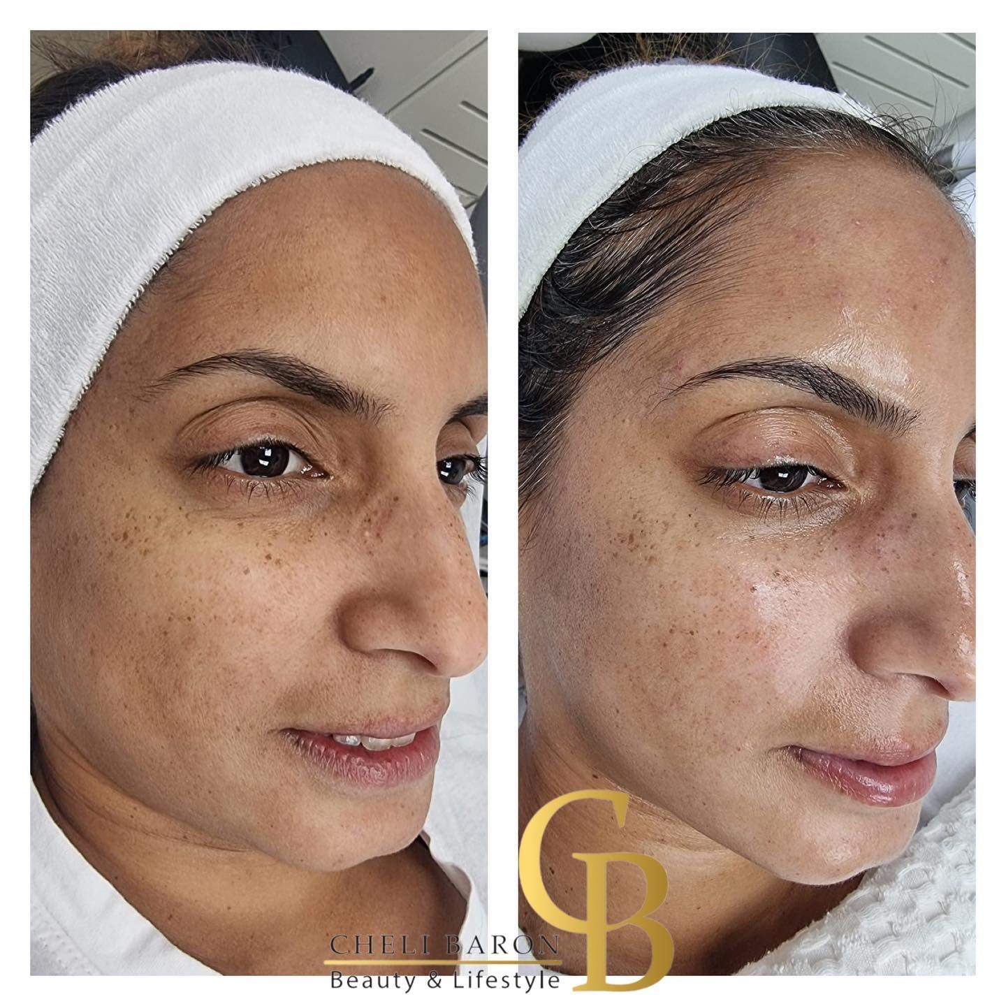 קוסמטיקאיות | חלי בראון המרכז לטיפולי לייזר ואסתטיקה