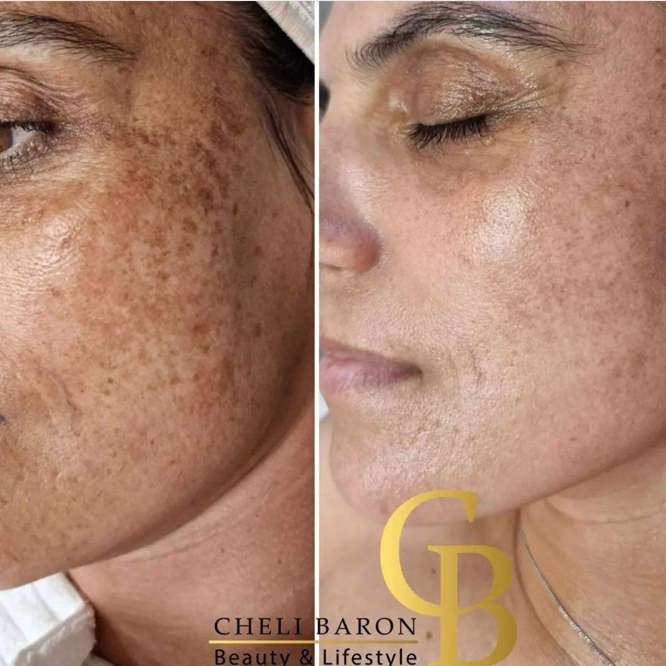 קוסמטיקאיות | חלי בראון המרכז לטיפולי לייזר ואסתטיקה