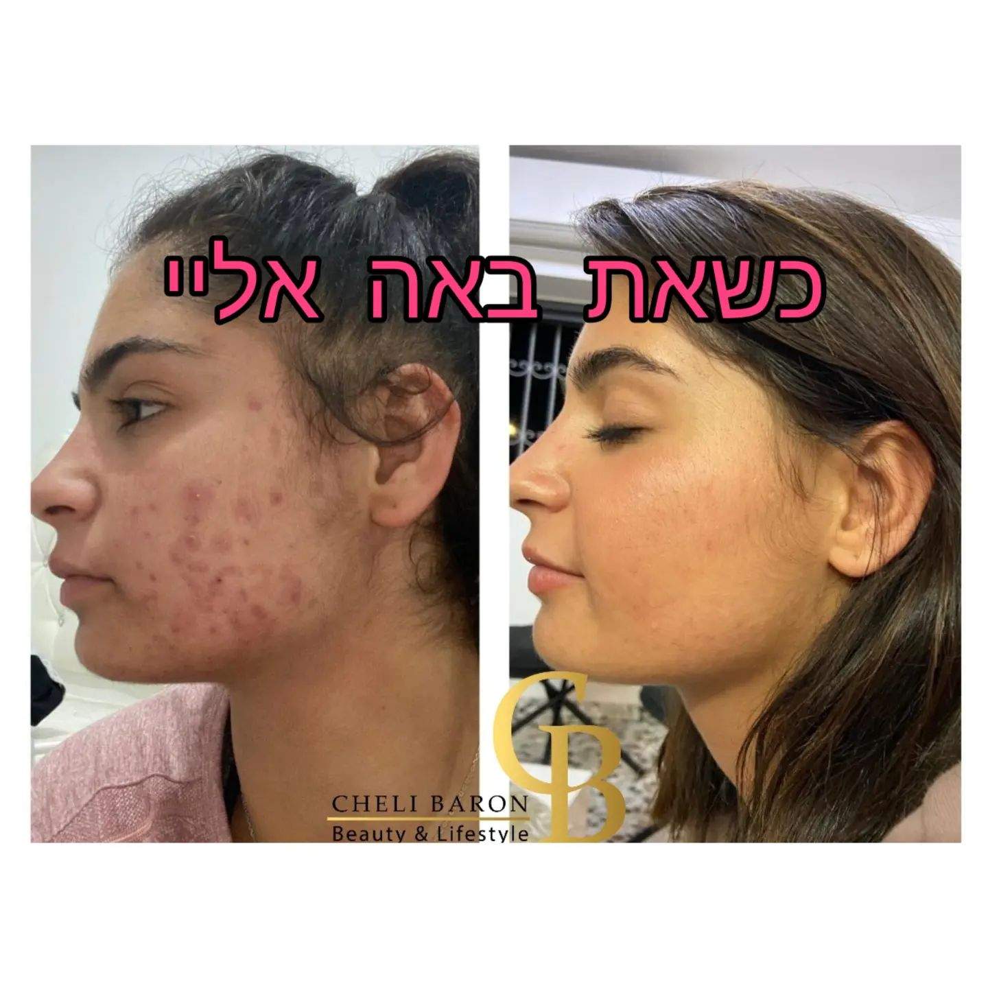 קוסמטיקאיות | חלי בראון המרכז לטיפולי לייזר ואסתטיקה