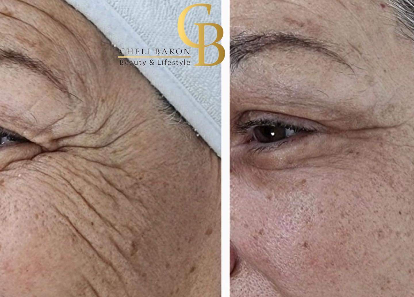 קוסמטיקאיות | חלי בראון המרכז לטיפולי לייזר ואסתטיקה