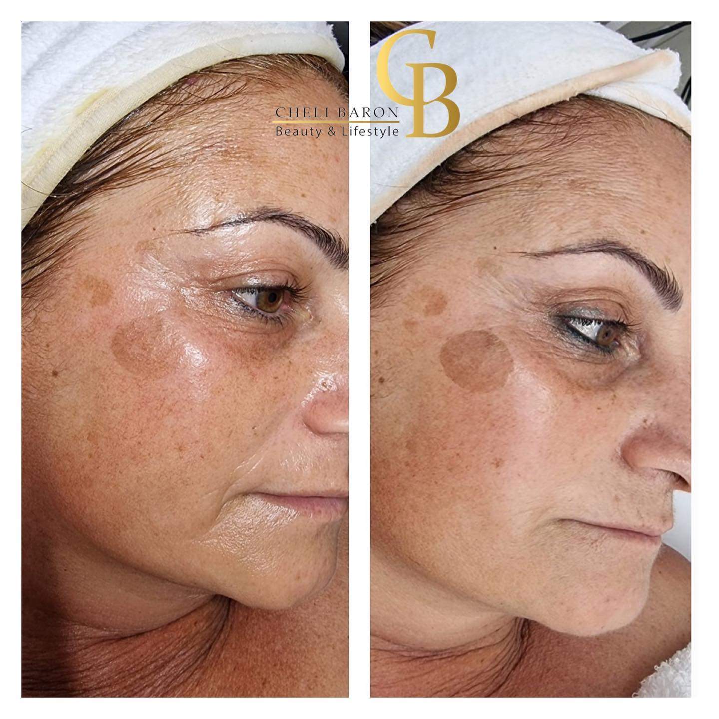 קוסמטיקאיות | חלי בראון המרכז לטיפולי לייזר ואסתטיקה