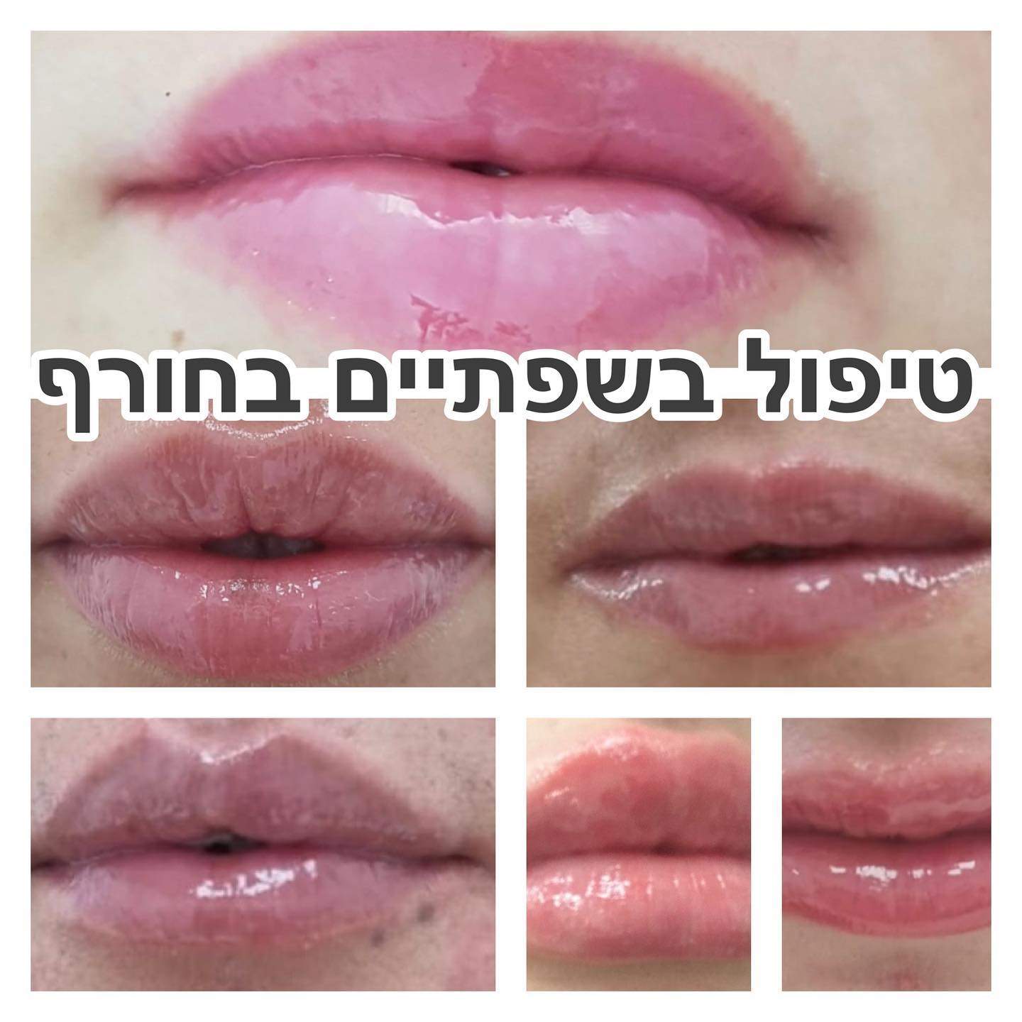 קוסמטיקאיות | חלי בראון המרכז לטיפולי לייזר ואסתטיקה