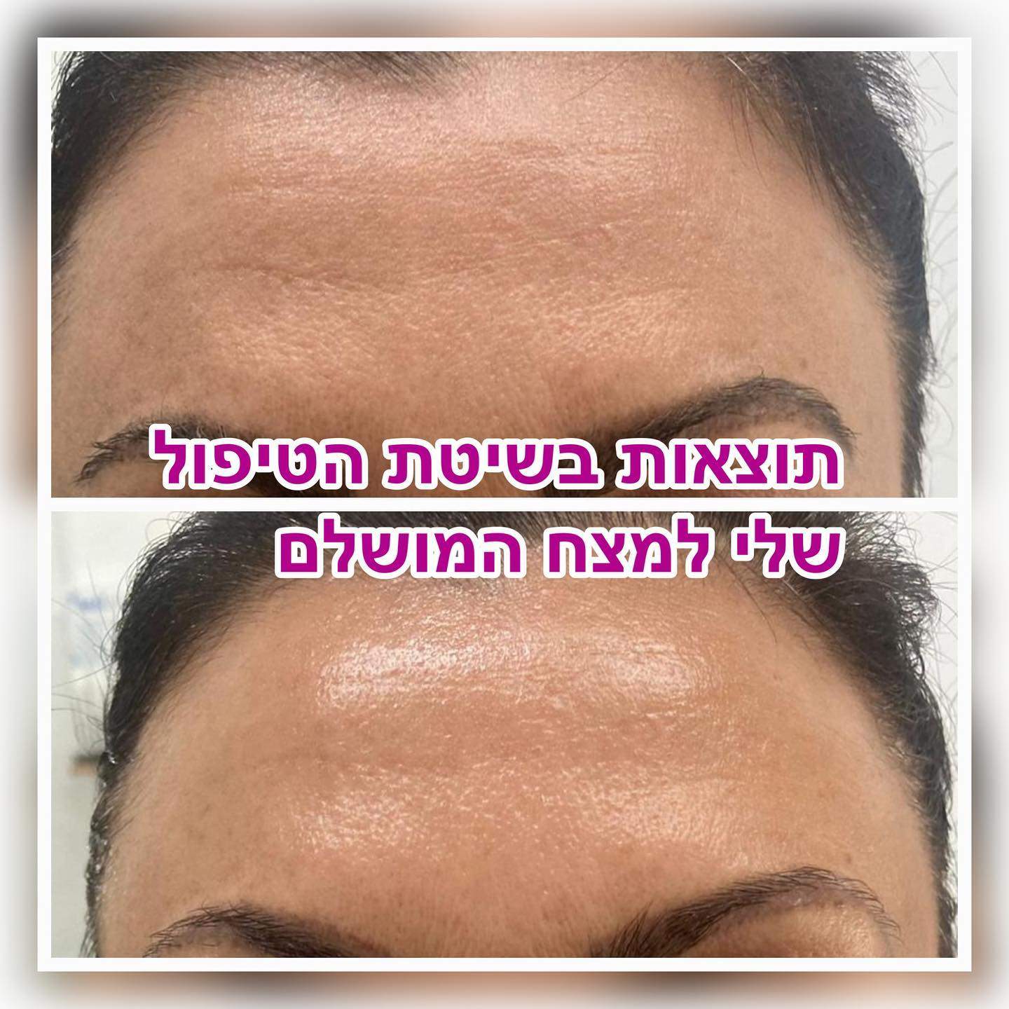 קוסמטיקאיות | חלי בראון המרכז לטיפולי לייזר ואסתטיקה