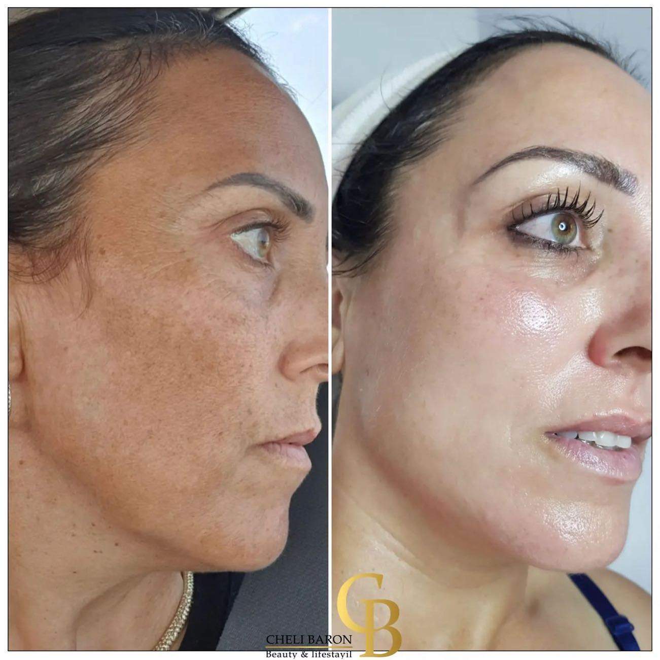 קוסמטיקאיות | חלי בראון המרכז לטיפולי לייזר ואסתטיקה