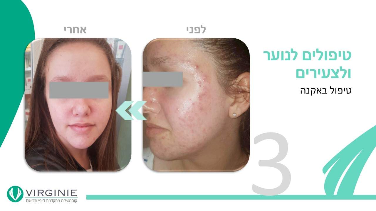 קוסמטיקאיות | וירג'יני קוסמטיקה מתקדמת ליופי ובריאות